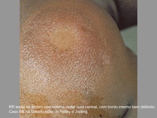 RR lesão no ombro com edema, notar cura central, com bordo interno bem definido.
Caso BB na classificação de Ridley e Jopling
 