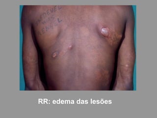 RR: edema das lesões
 