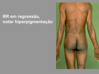RR em regressão,
notar hiperpigmentação
 