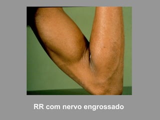 RR com nervo engrossado
 