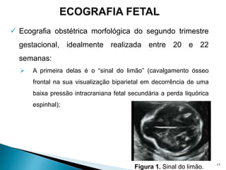  Ecografia obstétrica morfológica do segundo trimestre
gestacional, idealmente realizada entre 20 e 22
semanas:
 A primeira delas é o “sinal do limão” (cavalgamento ósseo
frontal na sua visualização biparietal em decorrência de uma
baixa pressão intracraniana fetal secundária a perda liquórica
espinhal);
Figura 1. Sinal do limão. 11
 