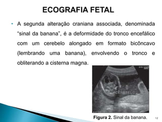 • A segunda alteração craniana associada, denominada
“sinal da banana”, é a deformidade do tronco encefálico
com um cerebelo alongado em formato bicôncavo
(lembrando uma banana), envolvendo o tronco e
obliterando a cisterna magna.
Figura 2. Sinal da banana. 12
 