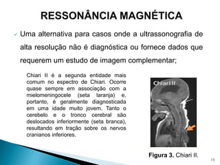  Uma alternativa para casos onde a ultrassonografia de
alta resolução não é diagnóstica ou fornece dados que
requerem um estudo de imagem complementar;
Chiari II é a segunda entidade mais
comum no espectro de Chiari. Ocorre
quase sempre em associação com a
mielomeningocele (seta laranja) e,
portanto, é geralmente diagnosticada
em uma idade muito jovem. Tanto o
cerebelo e o tronco cerebral são
deslocados inferiormente (seta branca),
resultando em tração sobre os nervos
cranianos inferiores.
Figura 3. Chiari II.
13
 