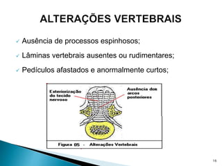 Ausência de processos espinhosos;
 Lâminas vertebrais ausentes ou rudimentares;
 Pedículos afastados e anormalmente curtos;
16
 