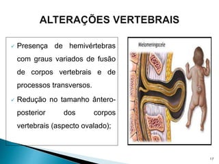  Presença de hemivértebras
com graus variados de fusão
de corpos vertebrais e de
processos transversos.
 Redução no tamanho ântero-
posterior dos corpos
vertebrais (aspecto ovalado);
17
 