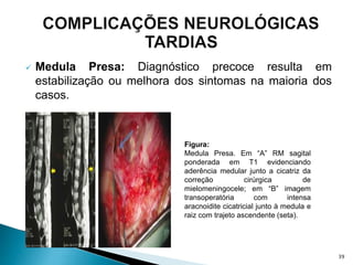  Medula Presa: Diagnóstico precoce resulta em
estabilização ou melhora dos sintomas na maioria dos
casos.
Figura:
Medula Presa. Em “A” RM sagital
ponderada em T1 evidenciando
aderência medular junto a cicatriz da
correção cirúrgica de
mielomeningocele; em “B” imagem
transoperatória com intensa
aracnoidite cicatricial junto à medula e
raiz com trajeto ascendente (seta).
39
 