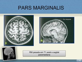 PARS MARGINALIS




   RM pesada em T1 axial e sagital
           paramediana
 