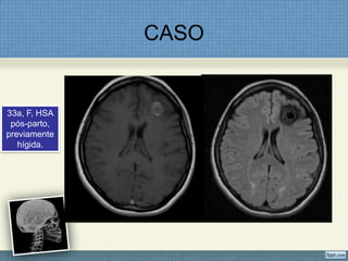 CASO


33a, F, HSA
 pós-parto,
previamente
   hígida.
 