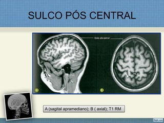 SULCO PÓS CENTRAL




  A (sagital apramediano); B ( axial); T1 RM
 