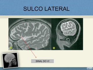 SULCO LATERAL




   SINAL DO V!
 