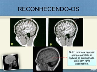 RECONHECENDO-OS




            Sulco temporal superior
              sempre paralelo ao
            Sylvius se prolongnado
                junto com ramo
                  ascendente.
 