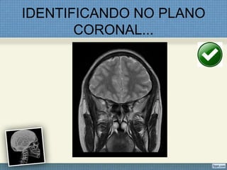 IDENTIFICANDO NO PLANO
       CORONAL...
 