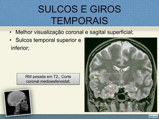 SULCOS E GIROS
              TEMPORAIS
• Melhor visualização coronal e sagital superficial;
• Sulcos temporal superior e
 inferior;




      RM pesada em T2,. Corte
      coronal medioesfenoidal;
 