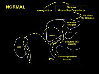 hemoglobina Sistema Monocítico Fagocitário FÍGADO RIM 85% Urobilinogênio fecal presente NORMAL bilirrubina não-conjugada bilirrubina conjugada bilirrubina biliar presente 