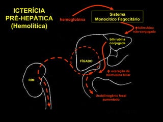 Sistema Monocítico Fagocitário FÍGADO RIM ICTERÍCIA PRÉ-HEPÁTICA (Hemolítica) hemoglobina  bilirrubina não-conjugada bilirrubina conjugada    excreção de bilirrubina biliar Urobilinogênio fecal aumentado 