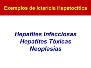Exemplos de Icterícia Hepatocítica Hepatites Infecciosas Hepatites Tóxicas Neoplasias 
