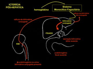 hemoglobina Sistema Monocítico Fagocitário bilirrubina conjugada FÍGADO RIM urobilinogênio fecal ausente ICTERÍCIA PÓS-HEPÁTICA refluxo de bilirrubina não-conjugada  urobilinogênio na urina: bilirrubina conjugada presente refluxo de bilirrubina conjugada secreção bilirrubina biliar ausente 