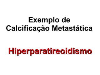 Exemplo de Calcificação Metastática Hiperparatireoidismo 