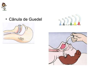 Cânula de Guedel 