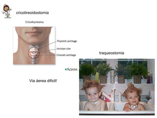 traqueostomia cricotireoidostomia Via áerea dificil! 