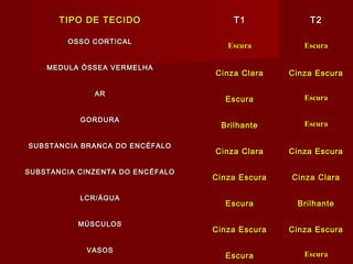 TIPO DE TECIDOTIPO DE TECIDO T1T1 T2T2
OSSO CORTICALOSSO CORTICAL
EscuraEscura EscuraEscura
MEDULA ÓSSEA VERMELHAMEDULA ÓSSEA VERMELHA
Cinza ClaraCinza Clara Cinza EscuraCinza Escura
ARAR
EscuraEscura EscuraEscura
GORDURAGORDURA
BrilhanteBrilhante EscuraEscura
SUBSTANCIA BRANCA DO ENCÉFALOSUBSTANCIA BRANCA DO ENCÉFALO
Cinza ClaraCinza Clara Cinza EscuraCinza Escura
SUBSTANCIA CINZENTA DO ENCÉFALOSUBSTANCIA CINZENTA DO ENCÉFALO
Cinza EscuraCinza Escura Cinza ClaraCinza Clara
LCR/ÁGUALCR/ÁGUA
EscuraEscura BrilhanteBrilhante
MÚSCULOSMÚSCULOS
Cinza EscuraCinza Escura Cinza EscuraCinza Escura
VASOSVASOS
EscuraEscura EscuraEscura
 