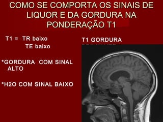 COMO SE COMPORTA OS SINAIS DECOMO SE COMPORTA OS SINAIS DE
LIQUOR E DA GORDURA NALIQUOR E DA GORDURA NA
PONDERAÇÃO T1PONDERAÇÃO T1
T1 = TR baixo
TE baixo
*GORDURA COM SINAL
ALTO
*H2O COM SINAL BAIXO
T1 GORDURA
BRILHANTE
 
