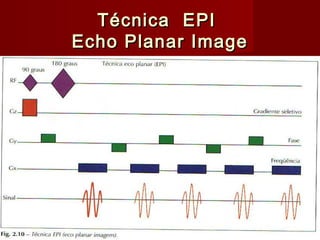Técnica EPITécnica EPI
Echo Planar ImageEcho Planar Image
 