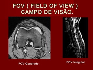 FOV ( FIELD OF VIEW )FOV ( FIELD OF VIEW )
CAMPO DE VISÃO.CAMPO DE VISÃO.
FOV Quadrado
FOV Irregular
 