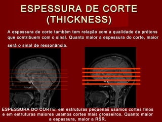ESPESSURA DE CORTEESPESSURA DE CORTE
(THICKNESS)(THICKNESS)
A espessura de corte também tem relação com a qualidade de prótonsA espessura de corte também tem relação com a qualidade de prótons
que contribuem com o sinal. Quanto maior a espessura do corte, maiorque contribuem com o sinal. Quanto maior a espessura do corte, maior
será o sinal de ressonância.será o sinal de ressonância.
ESPESSURA DO CORTE: em estruturas pequenas usamos cortes finos
e em estruturas maiores usamos cortes mais grosseiros. Quanto maior
a espessura, maior a RSR.
 