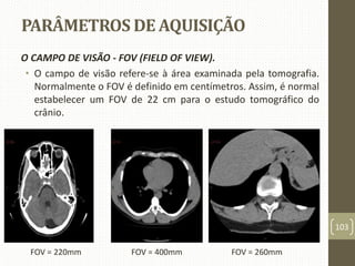 PARÂMETROS DE AQUISIÇÃO
O CAMPO DE VISÃO - FOV (FIELD OF VIEW).
• O campo de visão refere-se à área examinada pela tomografia.
Normalmente o FOV é definido em centímetros. Assim, é normal
estabelecer um FOV de 22 cm para o estudo tomográfico do
crânio.
103
FOV = 220mm FOV = 400mm FOV = 260mm
 