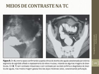 MEIOS DE CONTRASTE NA TC
TomografiaComputadorizada-
ProfWendesor
142
 