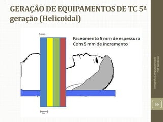 GERAÇÃO DE EQUIPAMENTOS DE TC 5ª
geração (Helicoidal)
TomografiaComputadorizada-
ProfWendesor
66
 