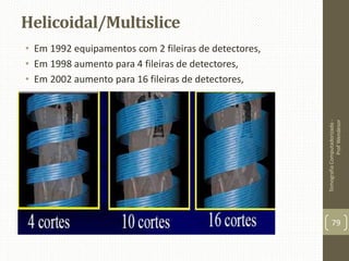Helicoidal/Multislice
• Em 1992 equipamentos com 2 fileiras de detectores,
• Em 1998 aumento para 4 fileiras de detectores,
• Em 2002 aumento para 16 fileiras de detectores,
TomografiaComputadorizada-
ProfWendesor
79
 