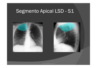 Segmento Apical LSDSegmento Apical LSDSegmento Apical LSDSegmento Apical LSD ---- S1S1S1S1
www.playmagem.com.br
 