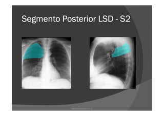 Segmento Posterior LSDSegmento Posterior LSDSegmento Posterior LSDSegmento Posterior LSD ---- S2S2S2S2
www.playmagem.com.br
 