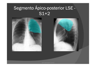 Segmento ÁpicoSegmento ÁpicoSegmento ÁpicoSegmento Ápico----posterior LSEposterior LSEposterior LSEposterior LSE ----
S1+2S1+2S1+2S1+2
www.playmagem.com.br
 