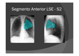 Segmento Anterior LSESegmento Anterior LSESegmento Anterior LSESegmento Anterior LSE ---- S2S2S2S2
www.playmagem.com.br
 