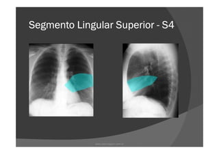 Segmento Lingular SuperiorSegmento Lingular SuperiorSegmento Lingular SuperiorSegmento Lingular Superior ---- S4S4S4S4
www.playmagem.com.br
 