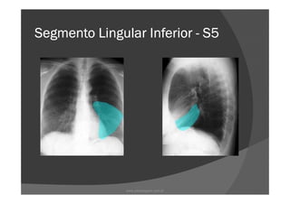 Segmento Lingular InferiorSegmento Lingular InferiorSegmento Lingular InferiorSegmento Lingular Inferior ---- S5S5S5S5
www.playmagem.com.br
 