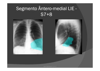 Segmento ÂnteroSegmento ÂnteroSegmento ÂnteroSegmento Ântero----medial LIEmedial LIEmedial LIEmedial LIE ----
S7+8S7+8S7+8S7+8
www.playmagem.com.br
 