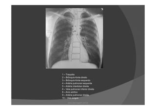 1 – Traquéia
2 – Brônquio-fonte direito
3 – Brônquio-fonte esquerdo
4 – Artéria pulmonar esquerda
5 – Artéria interlobar direita
6 – Veia pulmonar inferior direita
8 – Arco aórtico
9 – Artéria pulmonar direita
10 – Veia ázigos
www.playmagem.com.br
 
