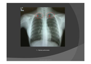 1 – Ápices pulmonares
www.playmagem.com.br
 