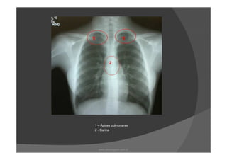 1 – Ápices pulmonares
2 - Carina
www.playmagem.com.br
 
