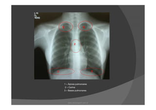 1 – Ápices pulmonares
2 – Carina
3 – Bases pulmonares
www.playmagem.com.br
 