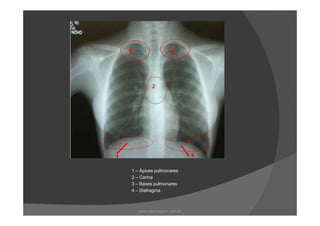 1 – Ápices pulmonares
2 – Carina
3 – Bases pulmonares
4 – Diafragma
www.playmagem.com.br
 