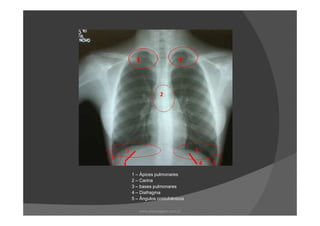 1 – Ápices pulmonares
2 – Carina
3 – bases pulmonares
4 – Diafragma
5 – Ângulos costofrênicos
www.playmagem.com.br
 