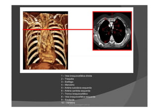 1 – Veia braquiocefálica direita
2 – Traquéia
3 – Esôfago
4 – Manúbrio
5 – Artéria subclávia esquerda
6 – Artéria carótida esquerda
7 – Tronco braquiocefálico
8 – Veia braquiocefálica esquerda
9 – Escápula
10 – Vértebra
www.playmagem.com.br
 