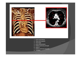 1 – Aorta ascendente
2 – Veia cava superior
3 – Veia ázigo
4 – Aorta descendente
5 – Artéria pulmonar principal
6 – esterno
7 – Artéria pulmonar esquerda
8 – Vértebra
www.playmagem.com.br
 
