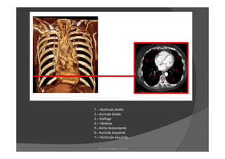 1 – Ventrículo direito
2 – Aurícula direita
3 – Esôfago
4 – Vértebra
5 – Aorta descendente
6 – Aurícula esquerda
7 – Ventrículo esquerdo
www.playmagem.com.br
 