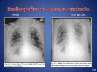 entrada   4 dias opós ext.




                             SRC
 